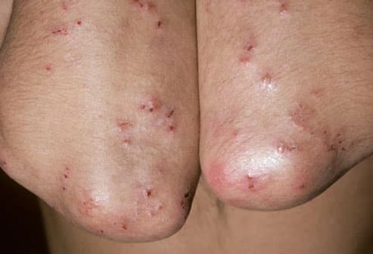 Top Complications of Untreated Celiac Disease in Adults